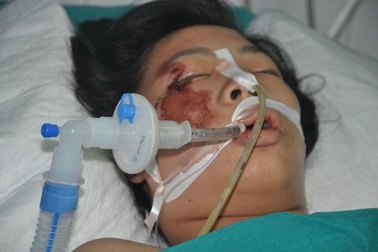 Tính mạng nguy kịch của nữ sinh bị tường đổ đè vào người trong cơn giông