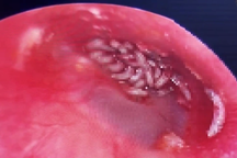 Gần 20 con giòi bò lúc nhúc trong tai người phụ nữ ở TPHCM