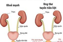 Ngăn ngừa ung thư tuyến tiền liệt