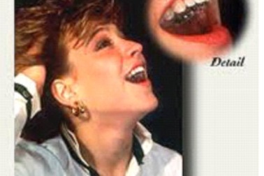 Niềng răng móm không cần phẫu thuật