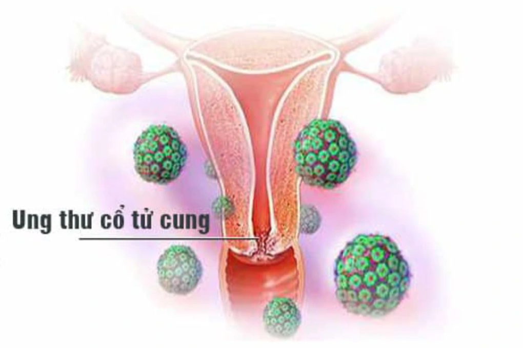Các phương pháp tầm soát ung thư cổ tử cung - 1 Các phương pháp tầm soát ung thư cổ tử cung - 1