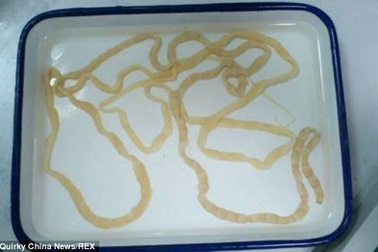 Phát hiện ổ sán dài 2 m trong ruột một phụ nữ Trung Quốc