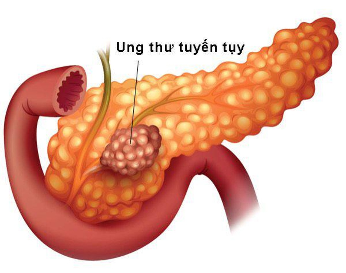 Thuốc trị huyết áp có thể giúp kiềm chế ung thư tuyến tụy? - 2 Thuốc trị huyết áp có thể giúp kiềm chế ung thư tuyến tụy? - 2