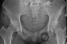 Thủ kim phòng "thượng mã phong" đêm tân hôn, cô gái bị kim chui vào người