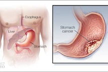 Những ai cần đề phòng bệnh ung thư dạ dày “gõ cửa”