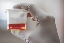 Bất thường khi đi tiểu cảnh báo ung thư bàng quang