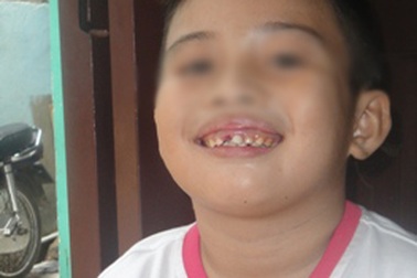 Giáo viên đánh học sinh lớp 2 gãy răng