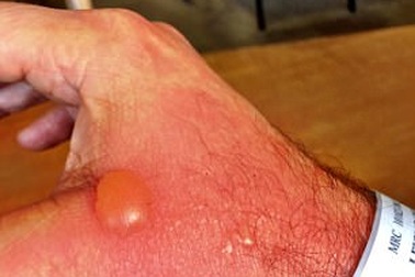 Bỏng độ 2 vì vắt nước cốt chanh dưới nắng