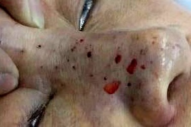 Hoại tử mũi, biến dạng mặt vì bơm chất làm đầy