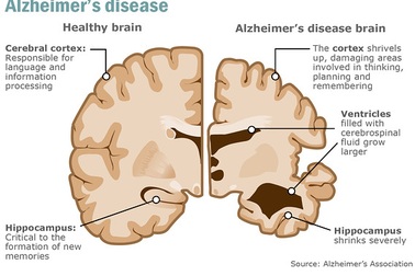 Sử dụng thuốc điều trị vi rút herpes để làm chậm bệnh Alzheimer