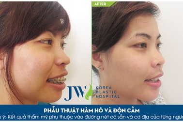 Nên lựa chọn niềng răng (chỉnh nha) hay phẫu thuật hàm