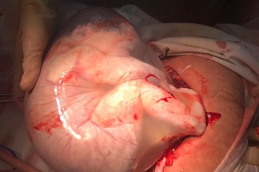 Hiếm gặp em bé chào đời trong bọc ối