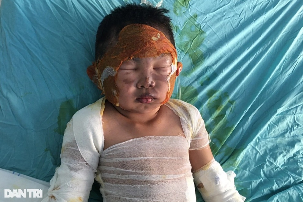 Lao vào biển lửa cứu con, tính mạng 2 bố con đang vô cùng nguy kịch - 6 Lao vào biển lửa cứu con, tính mạng 2 bố con đang vô cùng nguy kịch - 6