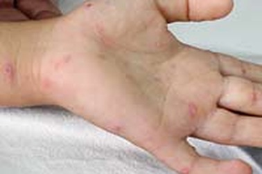 Phòng ngừa bệnh “chân, tay, miệng”