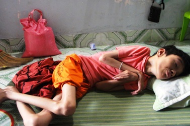 Chạnh lòng nhìn thiếu nữ xứ dừa chết mòn vì bại não