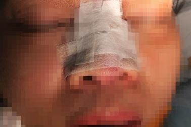 Vụ tiêm filler bị lấy hết vàng, cấp cứu: 2 lần uống thuốc "lạ" rồi thiếp đi