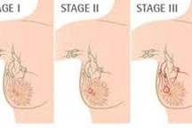 Phân loại các giai đoạn của ung thư vú như thế nào?
