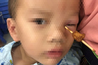 Bé 4 tuổi bị cây xiên thịt đâm thấu hốc mắt