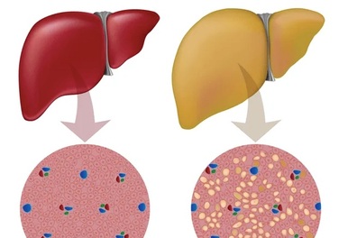 Ai dễ bị bệnh gan nhiễm mỡ?