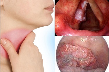 Nhận biết dấu hiệu ung thư thanh quản để không bỏ lỡ "thời gian vàng"