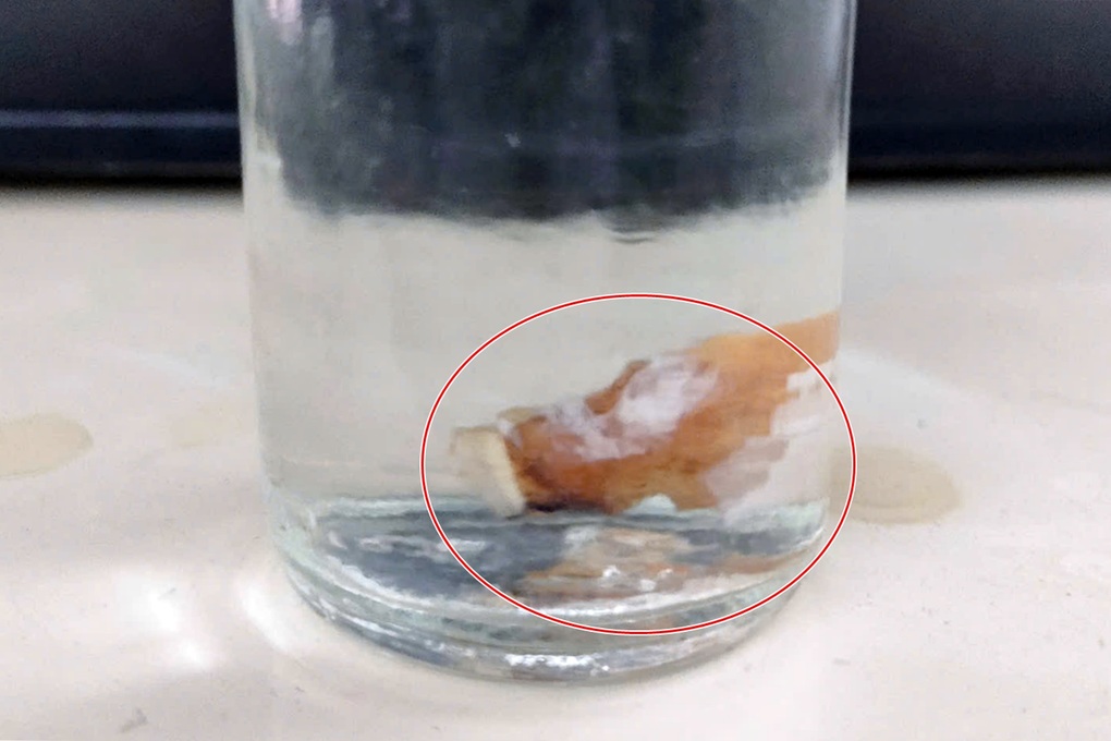 Răng giả mắc kẹt trong phổi của người đàn ông - 2 Răng giả mắc kẹt trong phổi của người đàn ông - 2