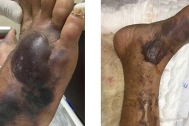 Khuẩn chết người từ hải sản sống, hàu sống gây tử vong như thế nào?