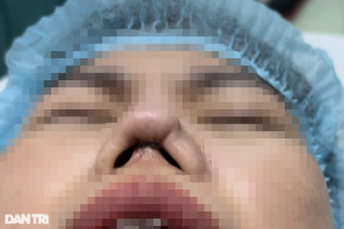 Ám ảnh của người phụ nữ 5 lần bị thẩm mỹ viện ở TPHCM phá nát mũi