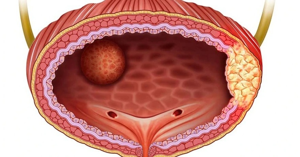 Phát hiện u bàng quang, có phải ung thư không? - 1