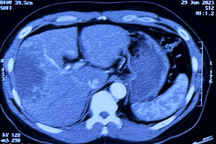 Căn bệnh ung thư 80% ca mắc phát hiện đã trễ, "tử thần" từ món gỏi cá sống