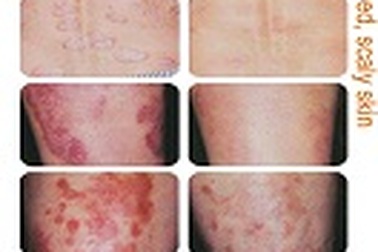 Giải pháp an toàn cho việc điều trị bệnh mề đay, mẩn ngứa