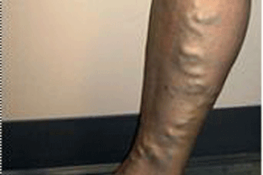 “Nổi gân” bắp chân, dấu hiệu suy tĩnh mạch chi