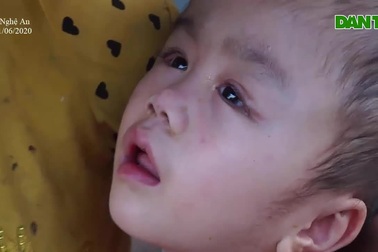 Xót xa cảnh cháu bé bị bệnh não úng thủy phải sống lay lắt.