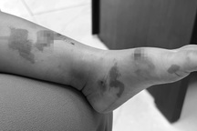 Hàng loạt cha mẹ đưa con đi viện cầu cứu vì phát bệnh chốc sau tựu trường