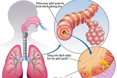 Làm gì khi trẻ hay bị viêm phế quản?