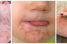 Làm thế nào để phòng ngừa bệnh tay chân miệng?