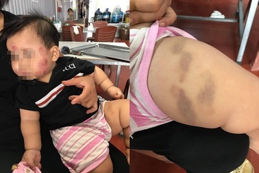 Bắc Giang: Bé 12 tháng bầm tím khắp người sau khi gửi trẻ