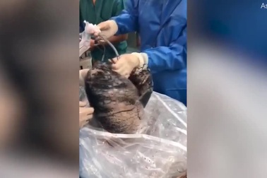 “Sốc” video phổi đen như than của người hút thuốc