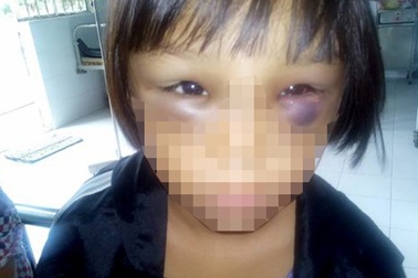 Nghi án bé gái 7 tuổi bị mẹ kế bạo hành