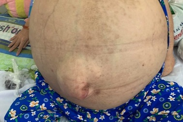 Nữ bệnh nhân 19 tuổi mang khối bướu khổng lồ như ễnh ương