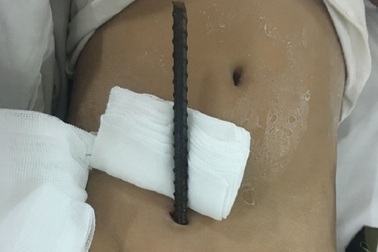 Bé 8 tuổi bị cây sắt xuyên từ vùng kín lên bụng