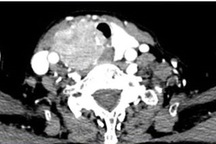 Khàn tiếng kéo dài, coi chừng ung thư tuyến giáp