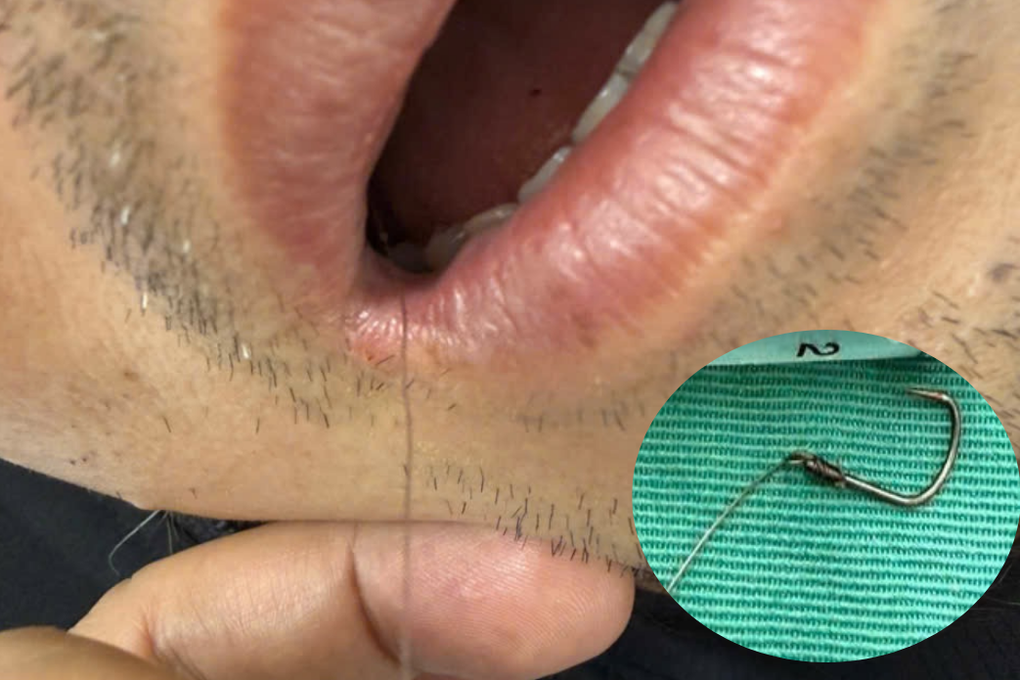 Hy hữu: Người đàn ông bị lưỡi câu mắc sâu trong thực quản khi ăn cá - 1