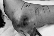 Đi bắt cua bị rắn cắn nguy kịch: Cảnh báo 3 sai lầm dễ hại chết trẻ