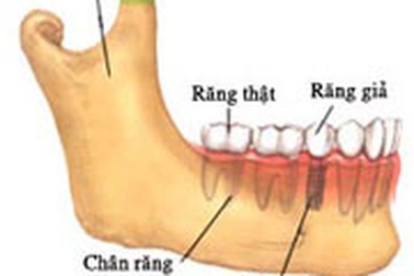 Cắm ghép nha - giải pháp tối ưu cho người muốn trồng răng mới