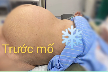 Cụ bà 85 tuổi mang khối u "khủng" như mang thai 9 tháng