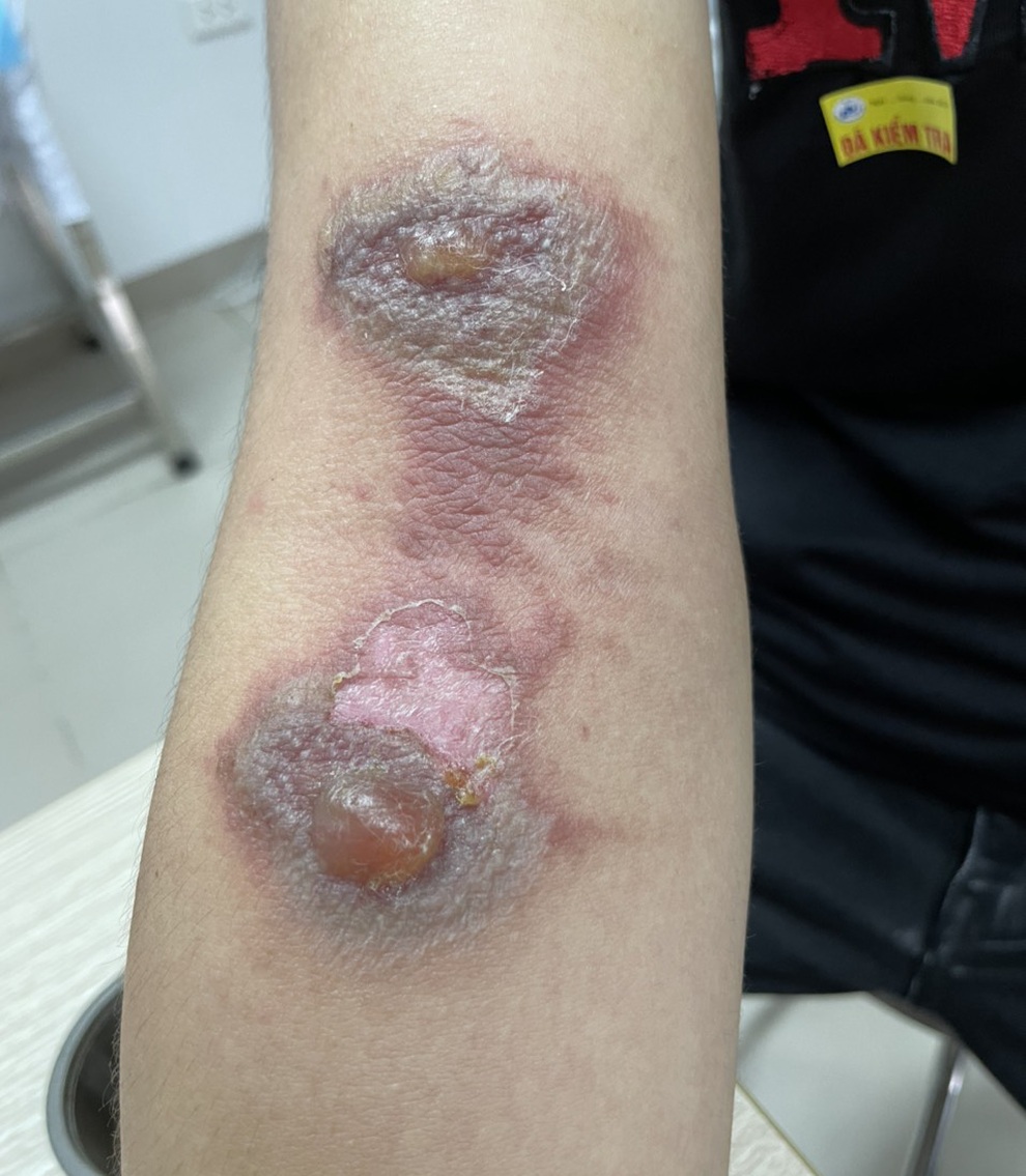 Sưng húp mắt, bỏng rộp, vằn vện khắp người sau một đêm vì kiến ba khoang - 4 Sưng húp mắt, bỏng rộp, vằn vện khắp người sau một đêm vì kiến ba khoang - 4