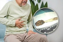 Người đàn ông phát hiện bàn chải đánh răng nằm trong ruột suốt 52 năm