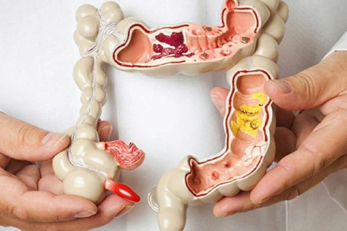 Đau bụng, đi ngoài lẫn máu: Cảnh giác căn bệnh có khả năng ung thư hóa - 1 Đau bụng, đi ngoài lẫn máu: Cảnh giác căn bệnh có khả năng ung thư hóa - 1