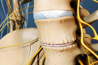 Cải thiện bệnh gai cột sống bằng cách cực kỳ đơn giản