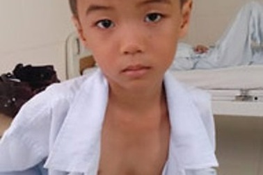 Cần Thơ: Phẫu thuật thành công cho bệnh nhân bị lõm xương ngực